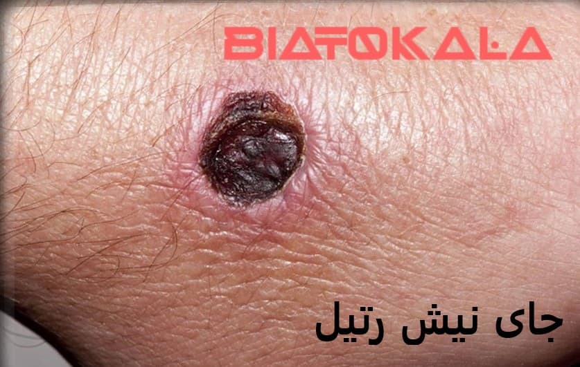 جای نیش رتیل